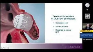 Novel Conformable Foam Based Implant for Left Atrial Appendage Closure - Dr. WilliamGray