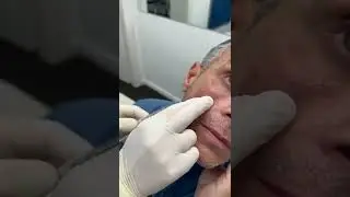 מיצוק עור הפנים | הליך פשוט ומקצועי עם תוצאות מדהימות | דר' דן רגב