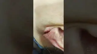 Essa orelha rasgou com brinco! 😮 e agora???