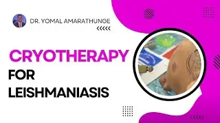 Cryotherapy For Leishmaniasis | Treatment for Cutaneous Leishmaniasis