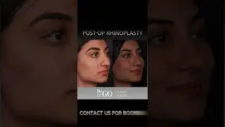 Before and After Rhinoplasty Operation - Dr Guncel Ozturk 