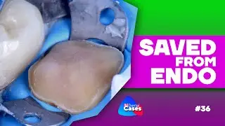 Saved from ENDO | BG Dental Cases #36