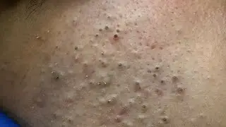 Deep Pore Cleansing for Acne | Satisfying Blackhead Extraction!