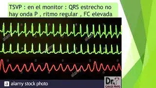 INTERPRETACION DEL ELECTROCARDIOGAMA PARTE 2