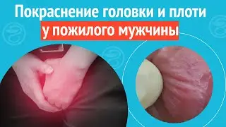 😦 Покраснение головки и плоти у пожилого мужчины. Клинический случай №1218