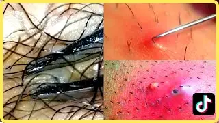 Ingrown Hair Removal Videos [compilations #19] Zoom 내성 모발 내성발톱 #ingrownhair #Shorts #RemovalHair