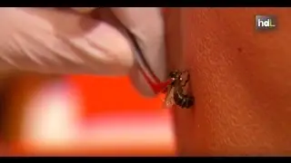 HDL Veneno que cura: picaduras de abejas para tratar dolencias
