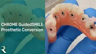 CHROME GuidedSMILE Prosthetic Conversion Process