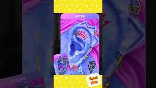 ear pimples and blackheads asmr👂🏻mermaid ear cleaning#asmr#bcoolamc#ytshortsvideo#shorts