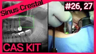 [Online Surgery] Crestal / #26, 27 / A-Oss Collagen