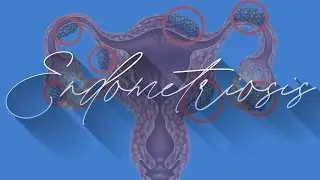 Endometriosis - Signs, Symptoms, Diagnosis & Treatment | Apollo Hospitals