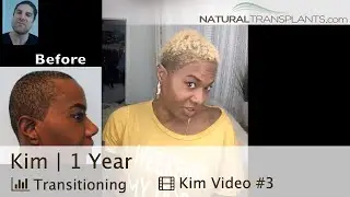 Transgender MTF Hair Transplant 1 Year Results | Dr. Matt Huebner (Kim)