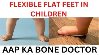Flexible FLATFEET IN CHILDREN - EPISODE 69