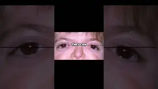 The Disappearing Wisdom Teeth  How Jaw Changes Affect Your Posture