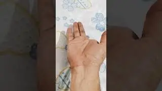 finger missing 
