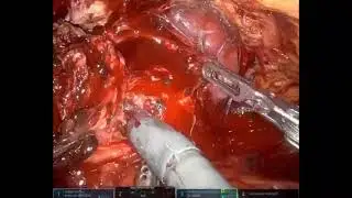 Salvage Prostatectomy After HIFU