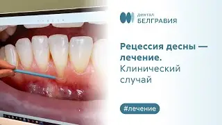 👉 Рецессия десны - лечение. Клинический случай