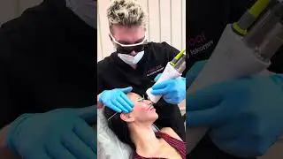 Laser facelift with Fotona 4D (step-by-step guidance by Dr. Andrey Iskornev)