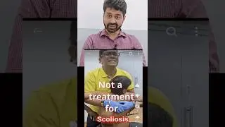 Scoliosis- This is is not how it's treated. Beware of quacks. #spine #scoliosistreatment #scoliosis