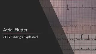 Atrial Flutter: ECG Findings Explained