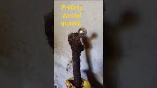fêmur com prótese #fêmur