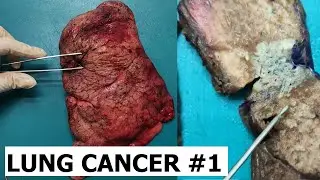 Peripheral lung cancer gross #1