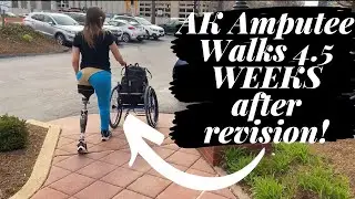 Walking Out Of Hanger Clinic 4.5 Weeks After Above Knee Revision On A Check Socket!