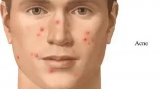 ব্রণ থেকে চিরতরে মুক্তির উপায়