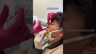 How To Fix Your Nose Without Surgery