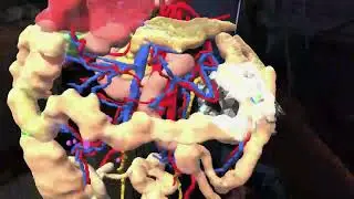 Intraoperative in-line holographic display of anatomy during laparoscopic right hemicolectomy