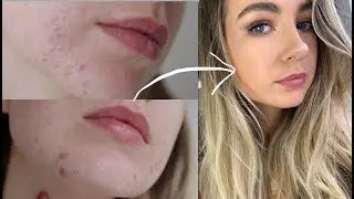 5 Skin Tips for Clear Skin / How I'm finally clearing my acne