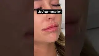 Lip Filler