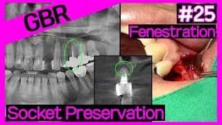 [Online Surgery] Socket preservation with collagenated graft(A-Oss Collagen) on damaged socket