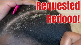 Dandruff Removal | Requested At Faster Speed