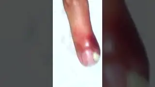 Black head removal on face - Blackheads on back treatment
