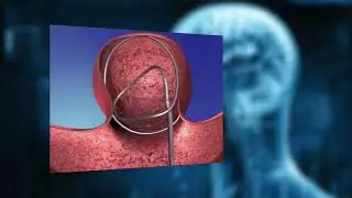 Stroke Awareness: Treatment for Stroke (Short)