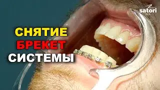 Removal of the braces system after 2 years of treatment