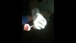 Erich's Elbow surgery