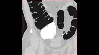 Virtual colonoscopy with retained fluid in right colon 2
