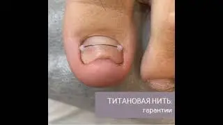 RUNNER TOE INJURIES. PROBLEM SOLVING. ТРАВМЫ ПАЛЬЦЕВ НОГ БЕГУНОВ. РЕШЕНИЕ ПРОБЛЕМ