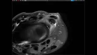 Traumatic TFCC Injury on MRI