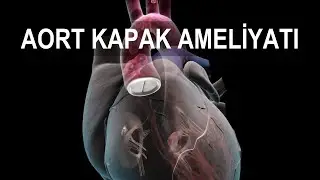 HEART VALVE SURGERY | Aortic Valve Surgery
