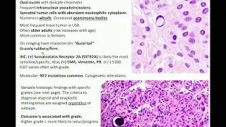 Meningiomas: Kurt's Notes 