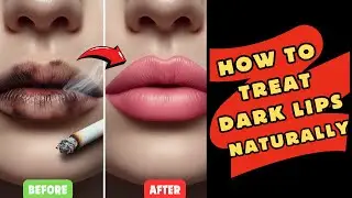 How To Get Rid of Dark Lips Permanently Naturally | How To Treat Dark Lips At Home