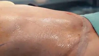 Dr.Vüsal Abdullayev - Plastik cərrah Abdominoplastika Əməliyyatı