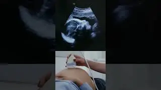 34 weeks active fetus | Ultrasound Case