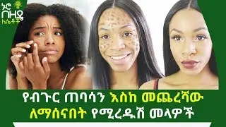 የብጉር ጠባሳን እስከ መጨረሻው ለማሰናበት የሚረዱሽ መላዎች | The best ways to get rid of acne scars | Nuro Bezede