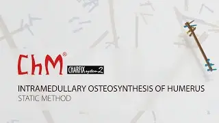 Intramedullary osteosynthesis of humerus with CHARFIX2 humeral nail - static method
