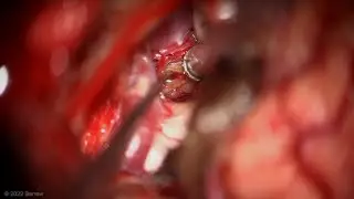 Transsylvian Approach for Interpeduncular Midbrain Cavernous Malformation