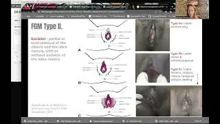 FGM/C Obstetric management